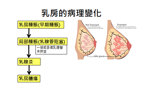 乳房病理變化.png