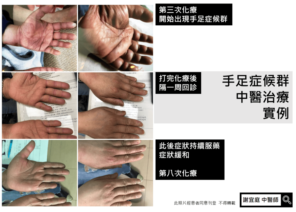 手足症候群 中醫 乳癌化療副作用 中醫婦科 謝宜庭
